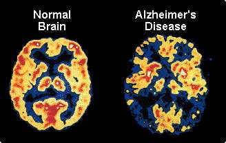 alzheimers-April-2011